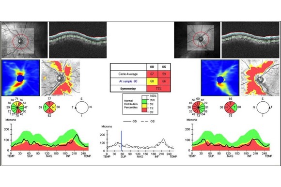 Analýza hrúbky nervových vlákien terča zrakového nervu- moderná diagnostika glaukómu
